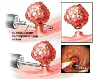 1) Электрокоагуляция