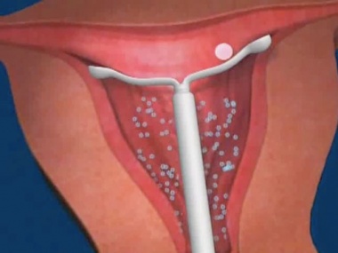 Установка внутриматочной спирали