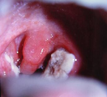 acute_tonsillitis.jpg acute_tonsillitis.jpg