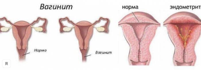 Диагностика и лечение эндоментрита у женщины Диагностика и лечение эндоментрита у женщины -