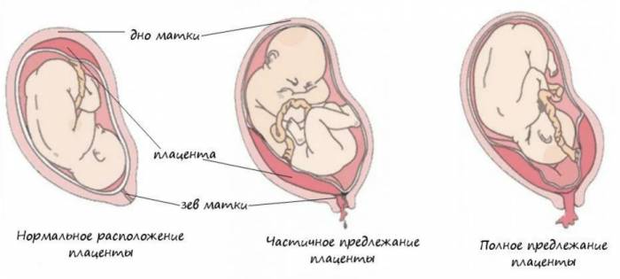 Низкая плацента при беременности Низкая плацента при беременности -