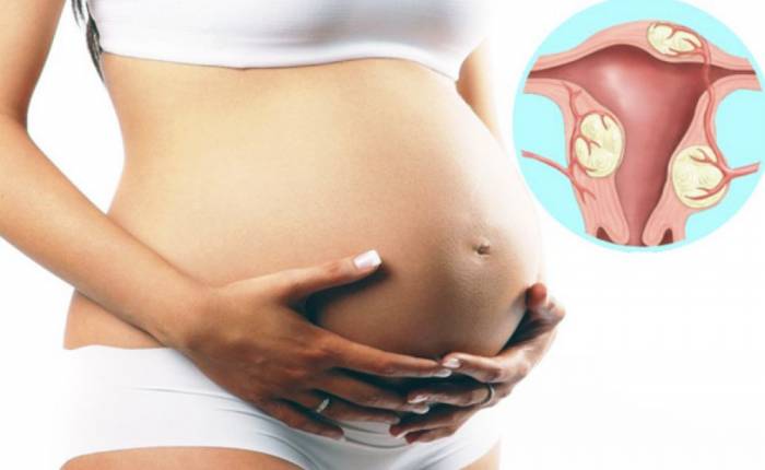 Причины появления миомы и её виды - Причины появления миомы и её виды