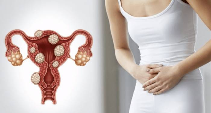 Лечение миомы матки до и во время беременности - Лечение миомы матки до и во время беременности