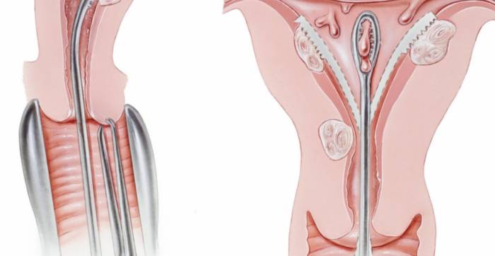 Показания к применению пайпель-биопсии - Показания к применению пайпель-биопсии