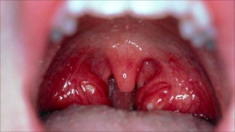 ангина1-768x432.jpg ангина1-768x432.jpg