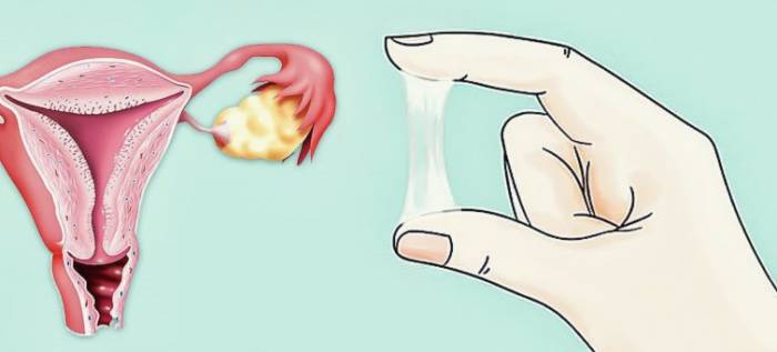 Что такое слизистая пробка - Что такое слизистая пробка