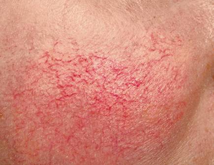 kuperoz-na-litse-foto.png kuperoz-na-litse-foto.png