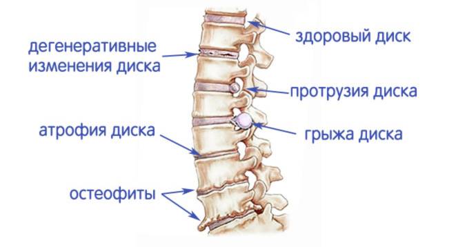 Дегенеративные заболевания позвоночника - Дегенеративные заболевания позвоночника