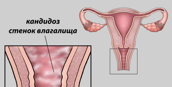 Диагностика молочницы при беременности - Диагностика молочницы при беременности