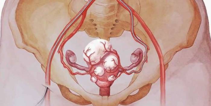 Диагностика, симптомы и признаки миомы матки - Диагностика, симптомы и признаки миомы матки
