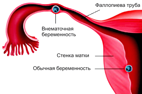 vnematochnaya-beremennost.gif vnematochnaya-beremennost.gif